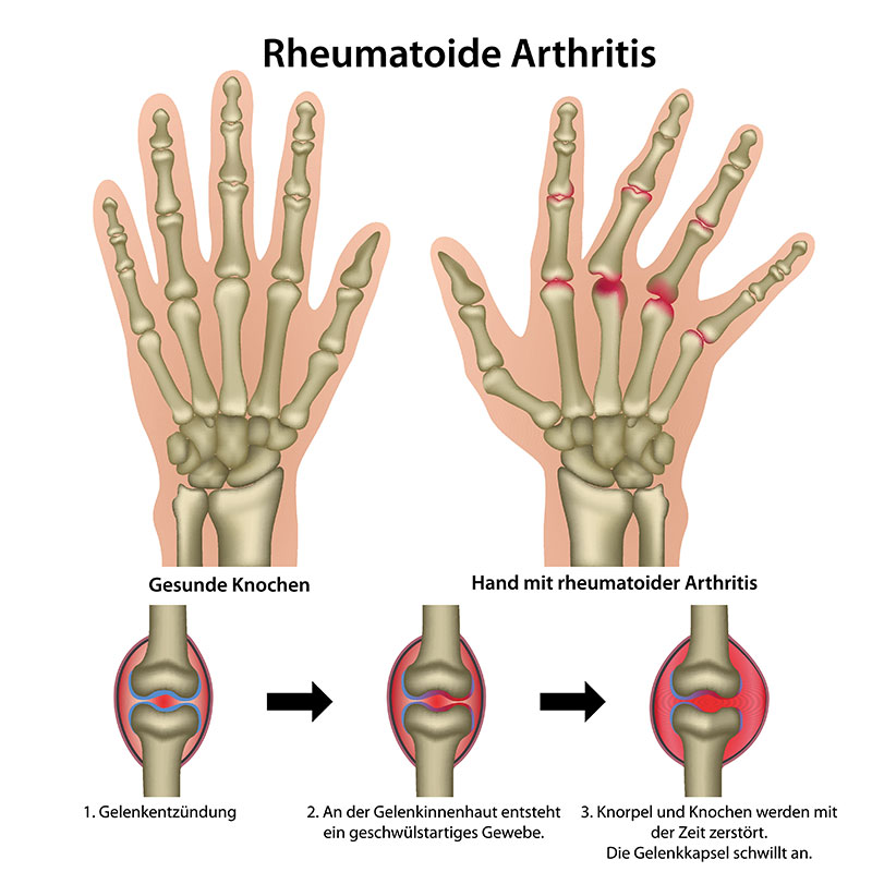 Symptome bei Polyarthritis Symptome bei Polyarthritis